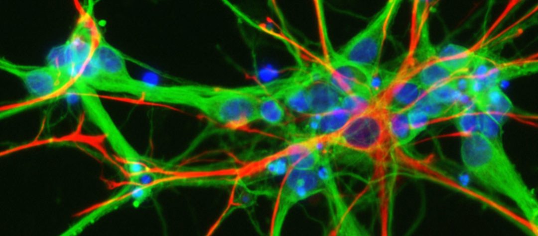 C9orf72 y su papel central en neurodegeneración