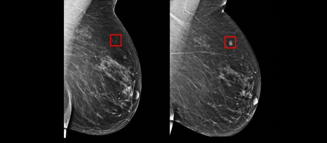 Biopsia líquida: un nuevo test en sangre podrá sustituir a la Mamografía