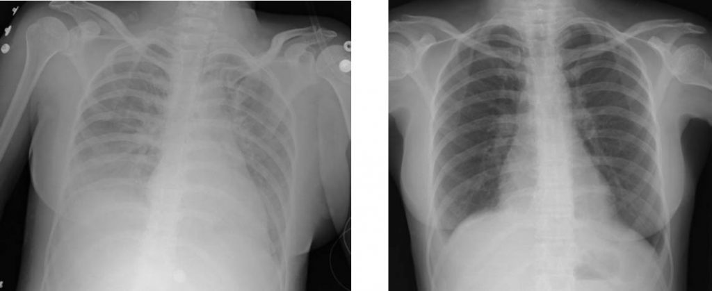 Radiografia de torax de lesion pulmonar aguda en comparacion con radiografia de torax de la misma persona despues del tratamiento 