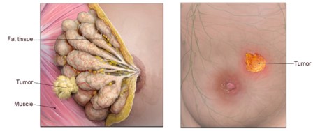 Cáncer de mama tumor