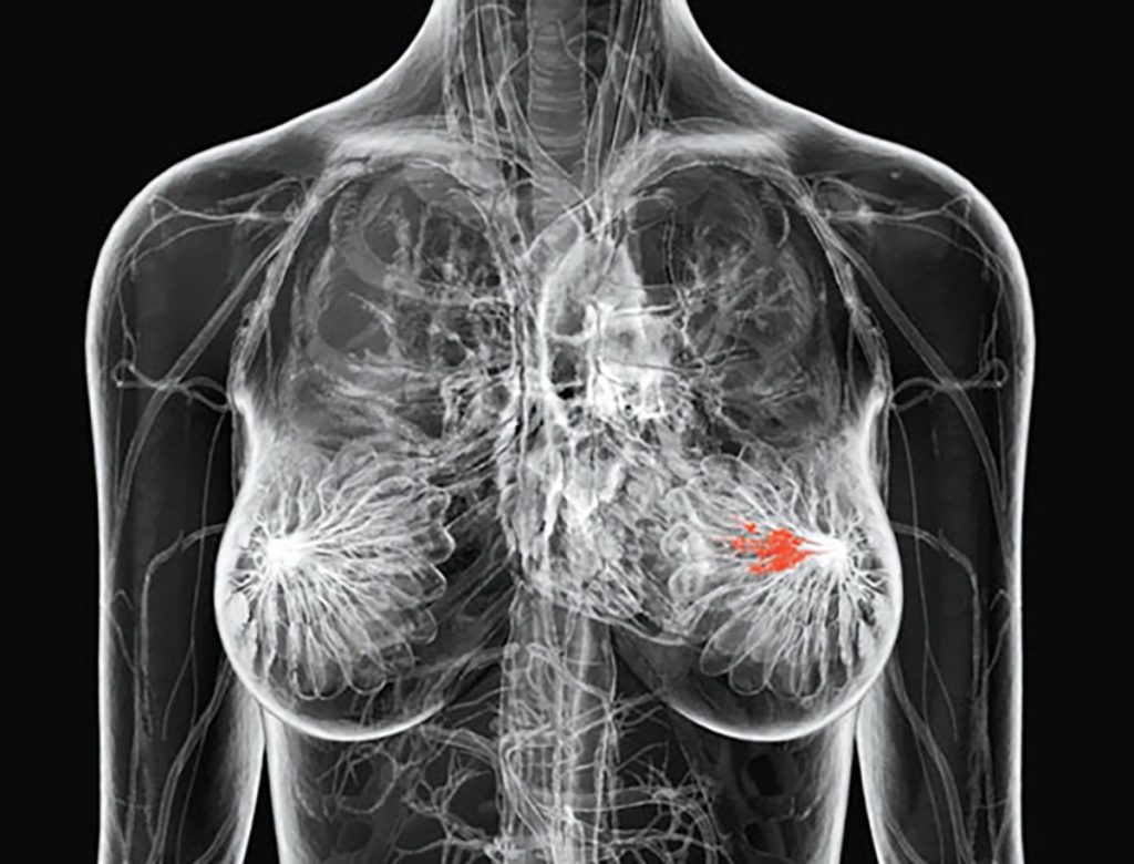 Biopsia liquida para detección precoz en cáncer de mama
